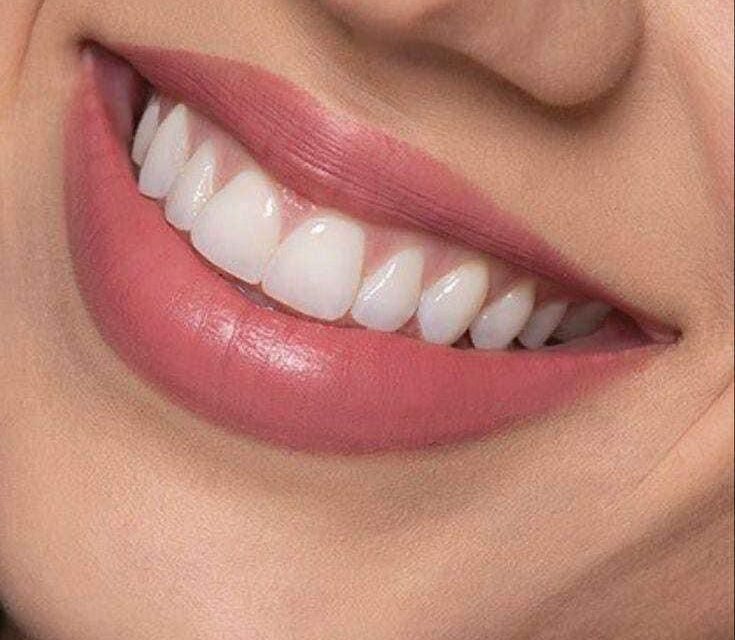 Carillas dentales: todo lo que necesitas saber para transformar tu sonrisa