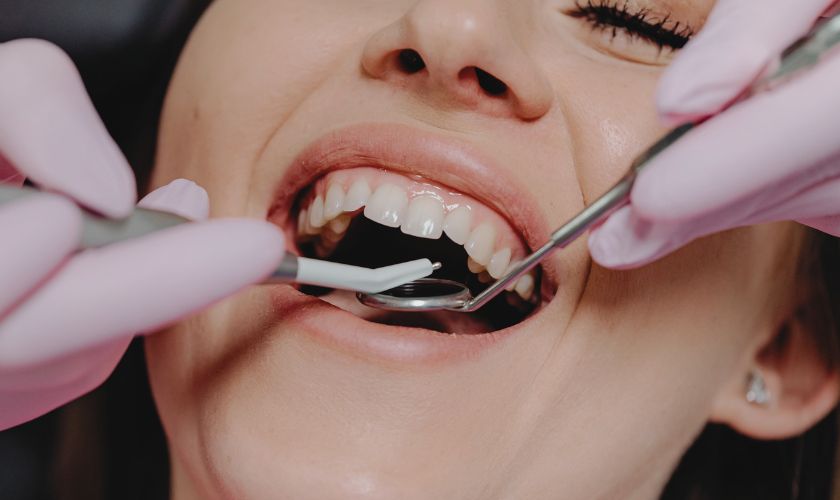 ¿Qué diferencias hay entre una fisura dental y una fractura dental?